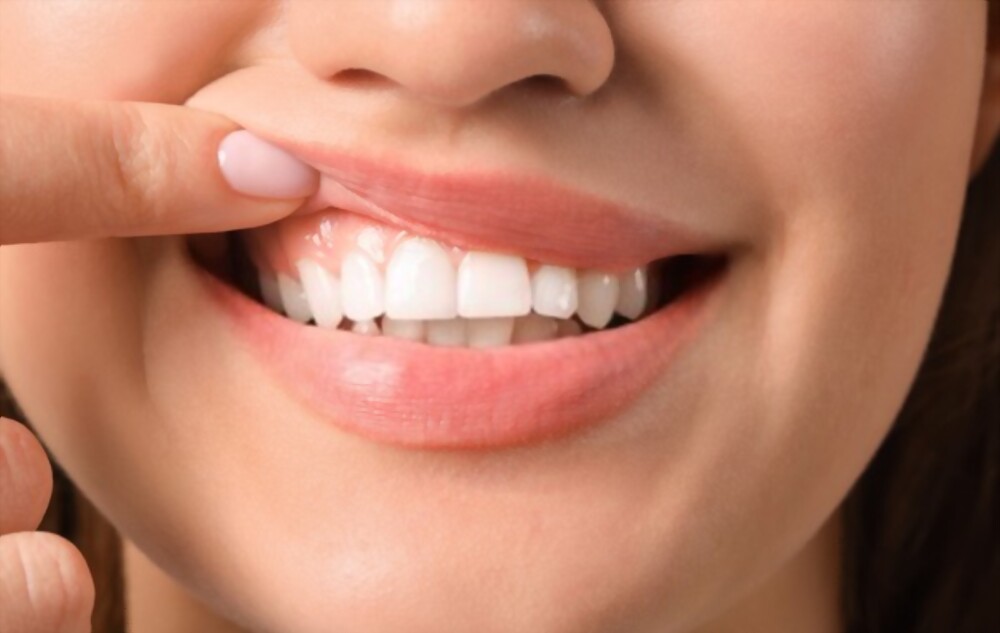 Gengivoplastia